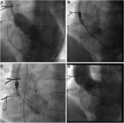 Valve-in-valve procedures for degenerated surgical and transcatheter aortic valve bioprostheses using a latest-generation self-expanding intra-annular transcatheter heart valve